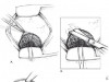 trabeculectomy
